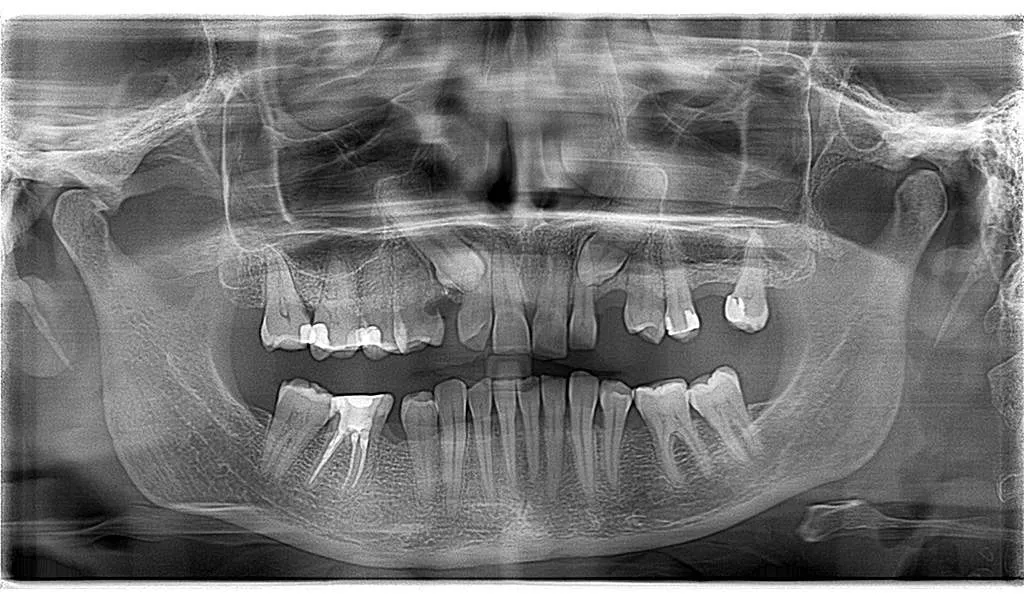 Radiografia-panoramica-dental-1-diente-impactado