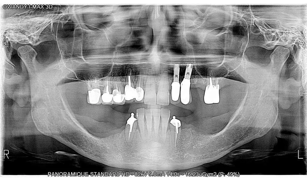 Radiografia panoramica dental