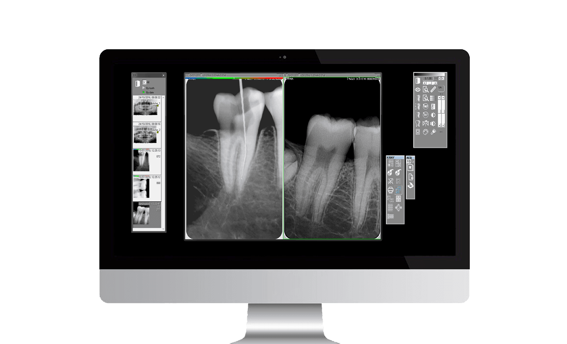 Radiografia de diente